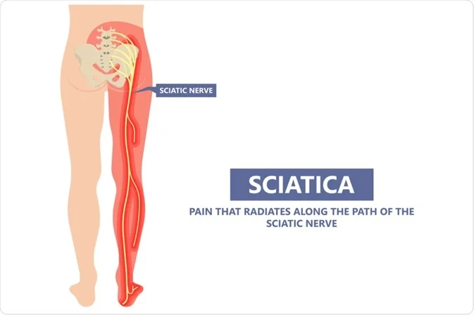 best treatment for sciatica pain in India