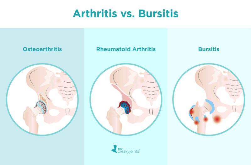 Interventional Hip Bursitis Treatment Hyderabad