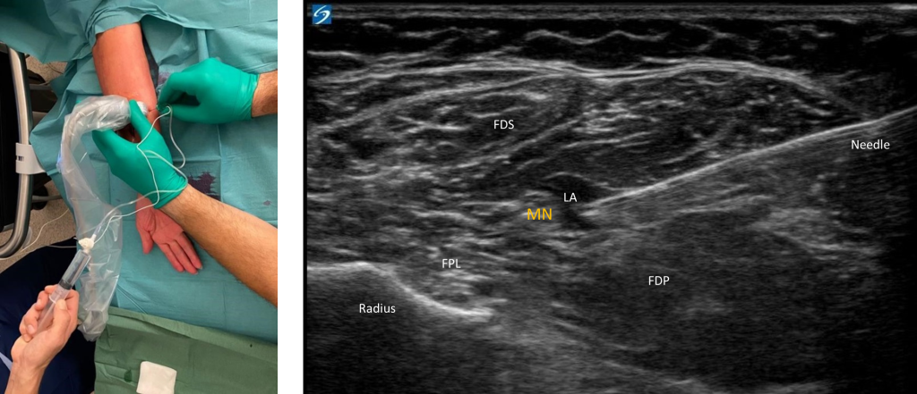What Is an Ultrasound-Guided Nerve Block