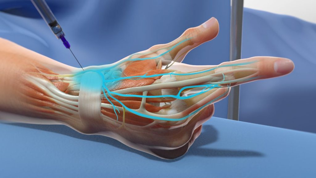  ultrasound-guided nerve block Cost in Hyderabad 
