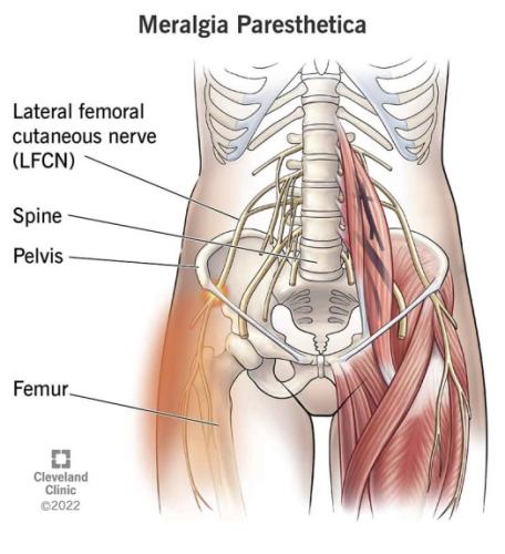 MERALGIA-PARESTHETICA-3