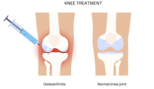 PRP-Knee1