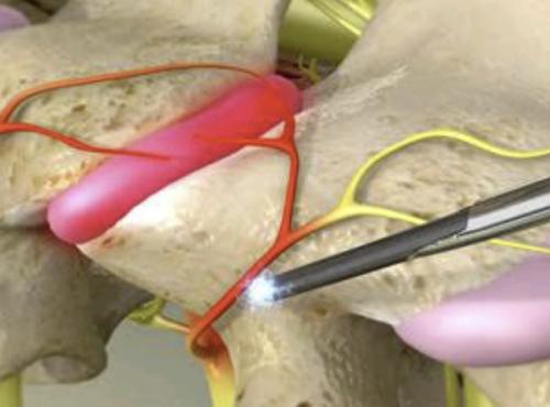 Radio-frequency-ablation2