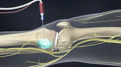 Radio-frequency-ablation3