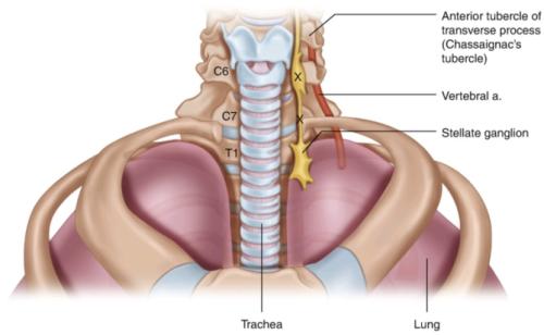 Stellate-ganglion-block1