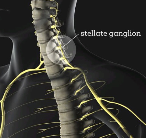 Stellate-ganglion-block2