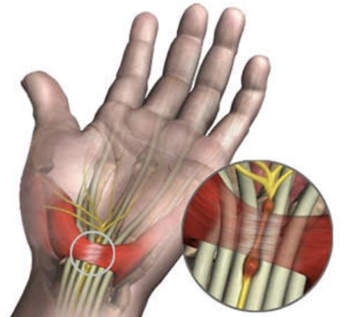 carpal-tunnel-syndrome2