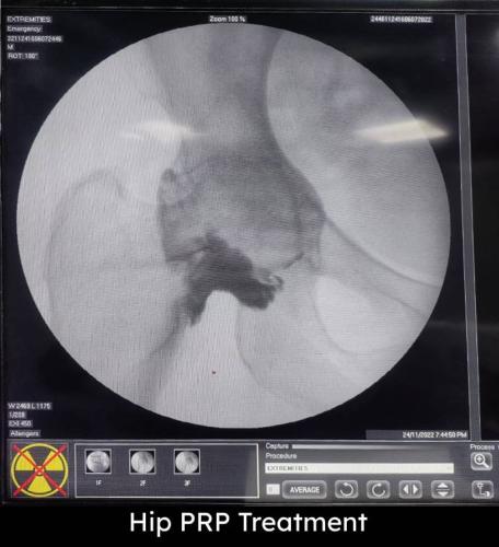 hip-prp-treatment