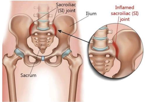 sacroiliac-joint-injection1